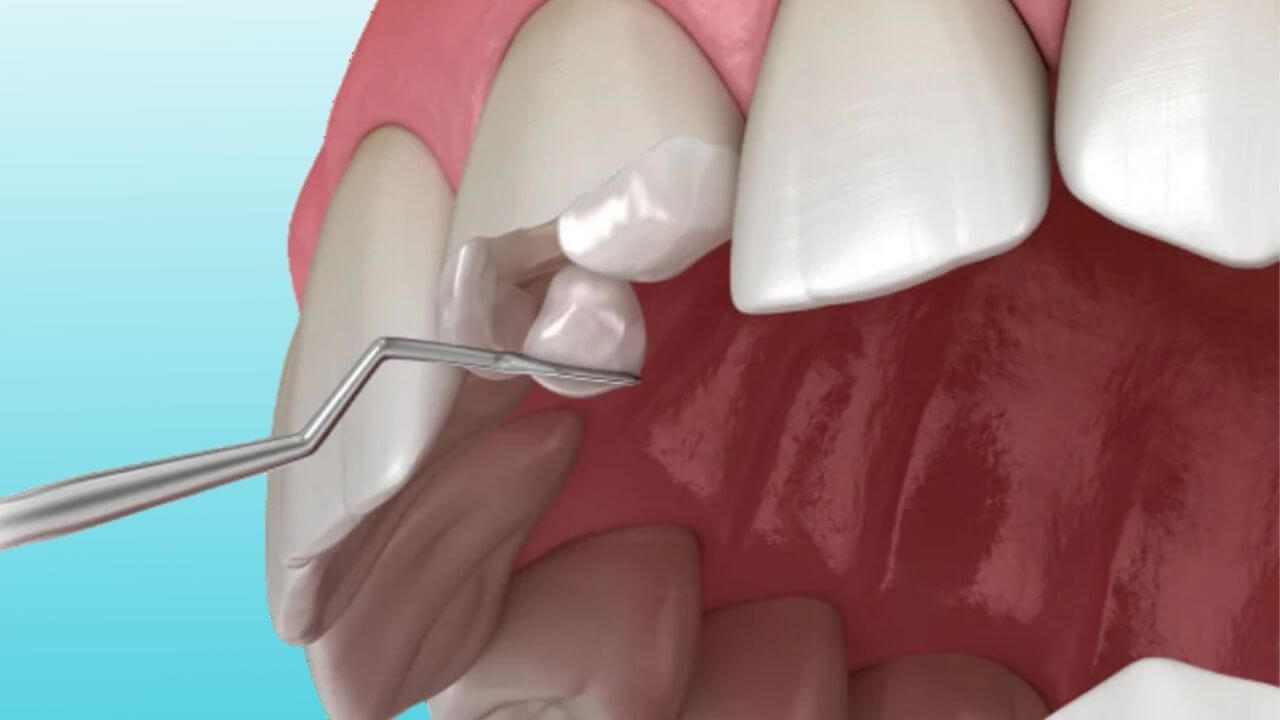 Cosmetic Dentistry Treatment in Gangapur Road Nashik | Care 32 Dental