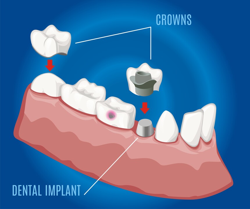Crowns, Caps, Bridges & Dentures in Canada Corner Nashik