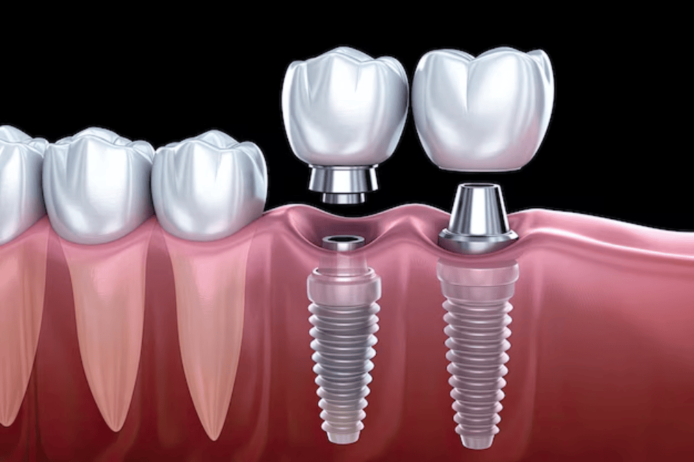 Dental Implant in Mahatma Nagar Nashik