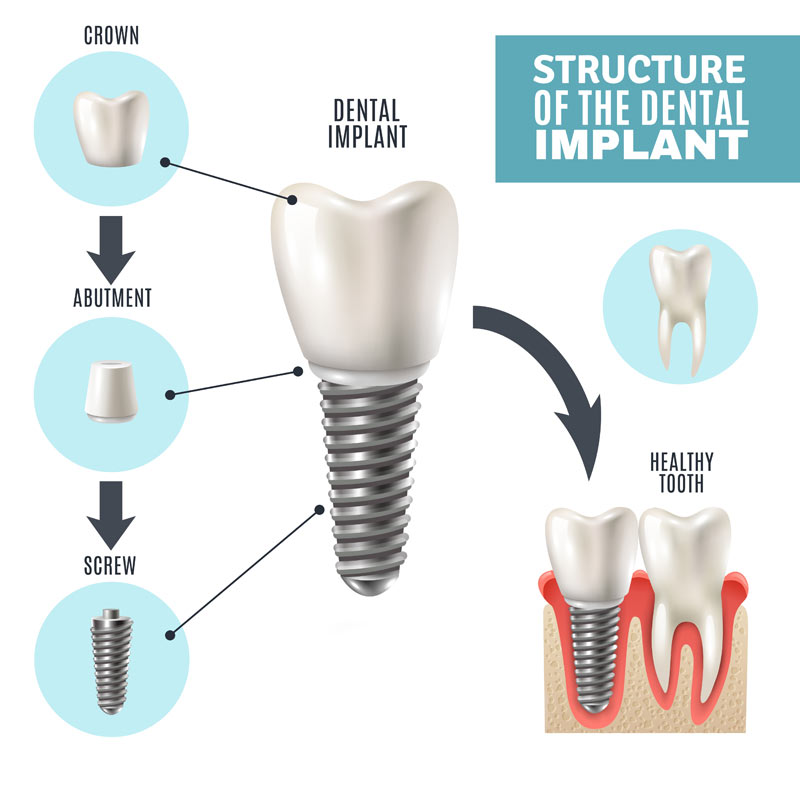 Dental Implant in Sharanpur Road Nashik | Care 32 Dental