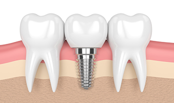 Dental Implants near Gangapur Road Nashik | Care 32 Dental and Implant Centre