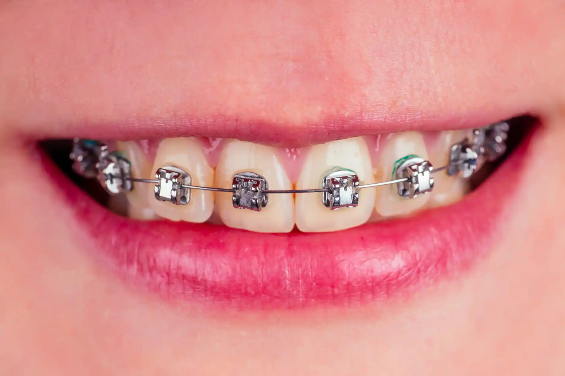 Orthodontics for Adults: Why Braces Aren’t Just for Kids