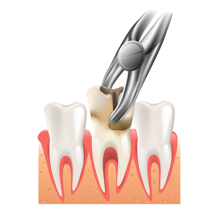 Painless Root Canal Treatment in Nashik | Care 32 Clinic