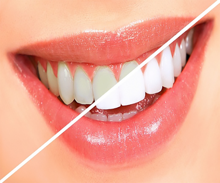 Teeth Whitening in College Road Nashik - Care32 Dental Clinic