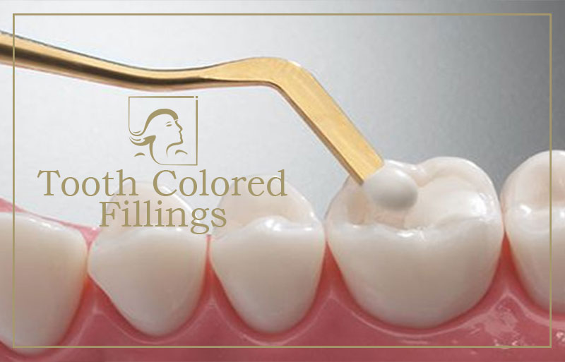 Tooth Color Fillings in Gangapur Road Nashik