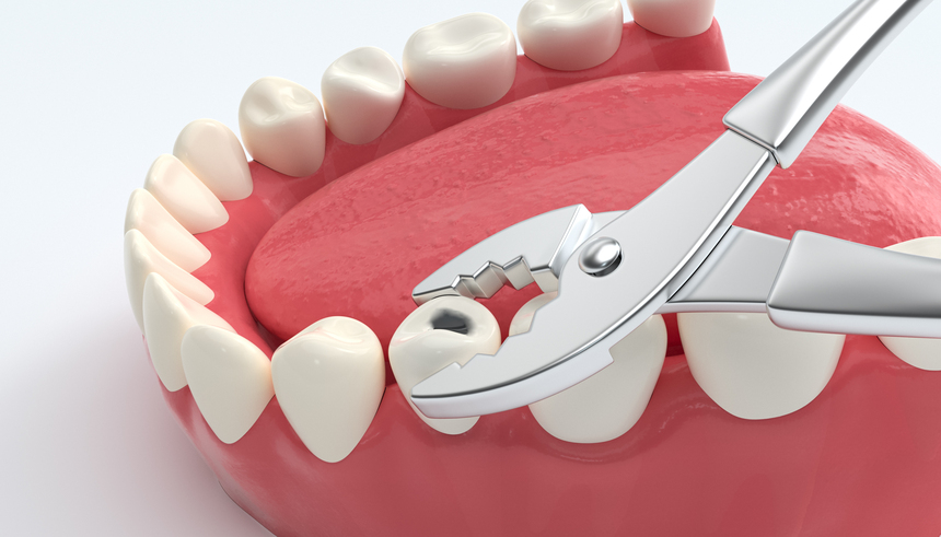 Tooth Extraction Treatment Clinic in Nashik | Care 32 Dental